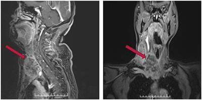 A Novel Multimodal Therapy for Anaplastic Thyroid Carcinoma: 125I Seed Implantation Plus Apatinib After Surgery